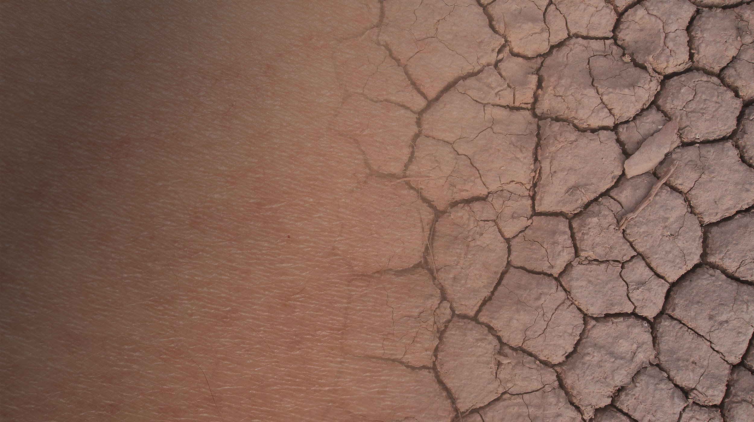 Skin Dehydration