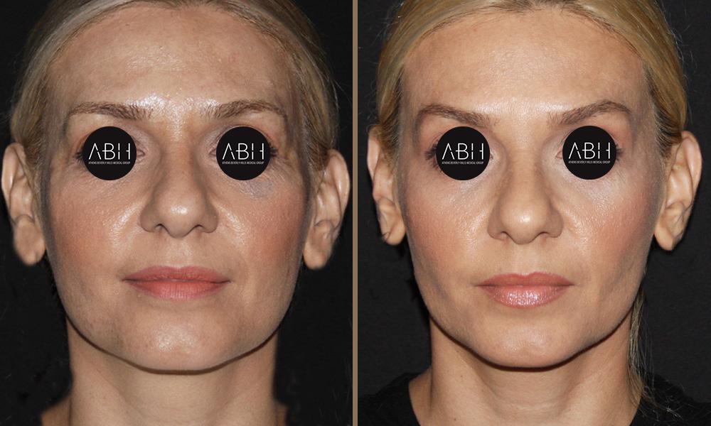 Biomimetic Peptide Protocol 5 Πριν & Μετά - Fillers Υαλουρονικού Οξέος