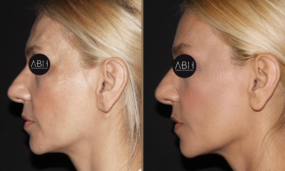 Biomimetic Peptide Protocol 6 Πριν & Μετά - Fillers Υαλουρονικού Οξέος