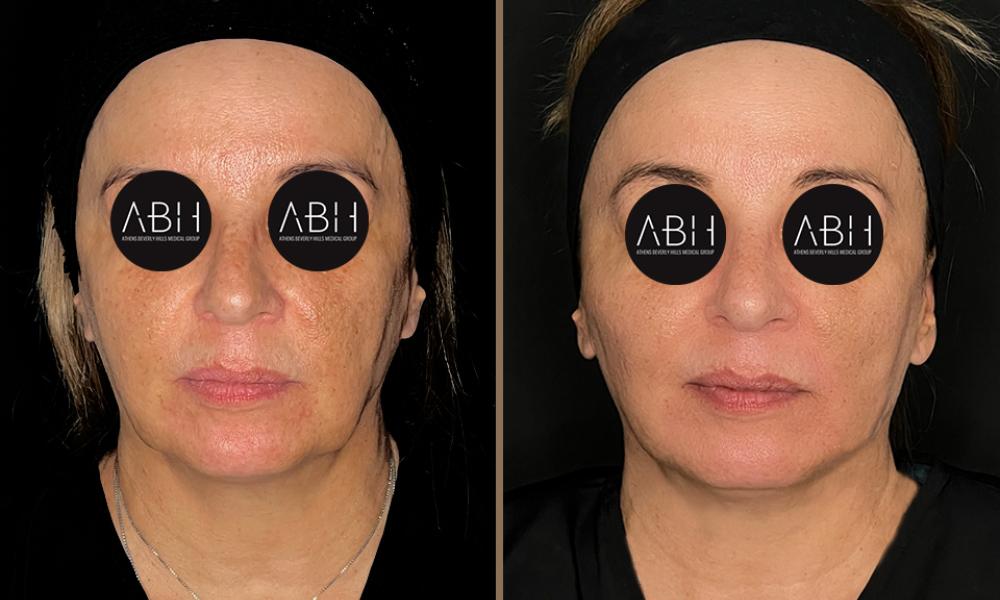 Biomimetic Peptide Protocol 8 Πριν & Μετά - Fillers Υαλουρονικού Οξέος
