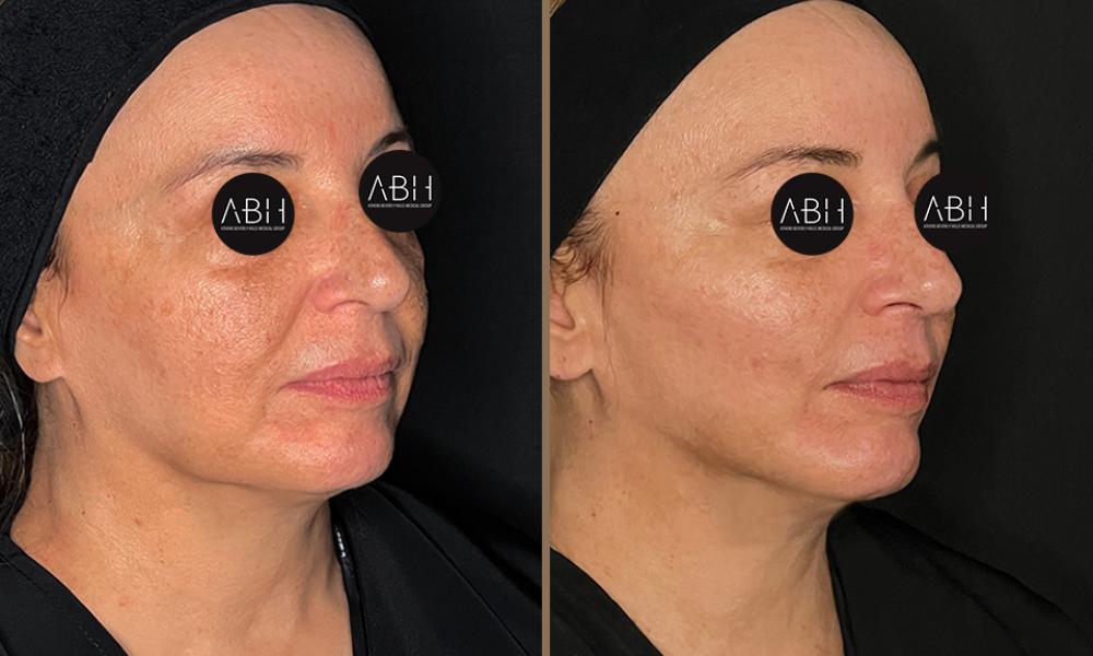 Biomimetic Peptide Protocol 9 Πριν & Μετά - Fillers Υαλουρονικού Οξέος