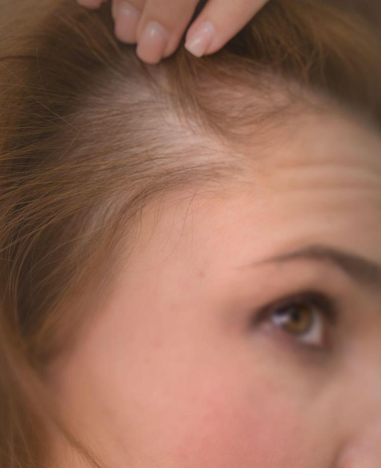 alopekia