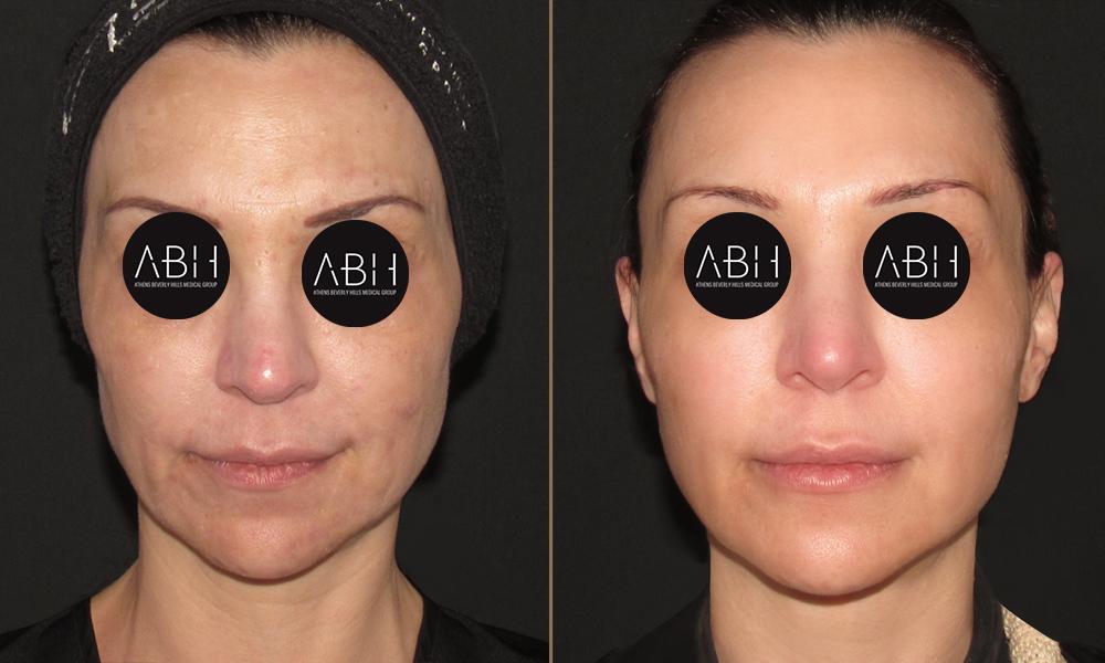 Biomimetic Peptide Protocol 10 Πριν & Μετά - Fillers Υαλουρονικού Οξέος