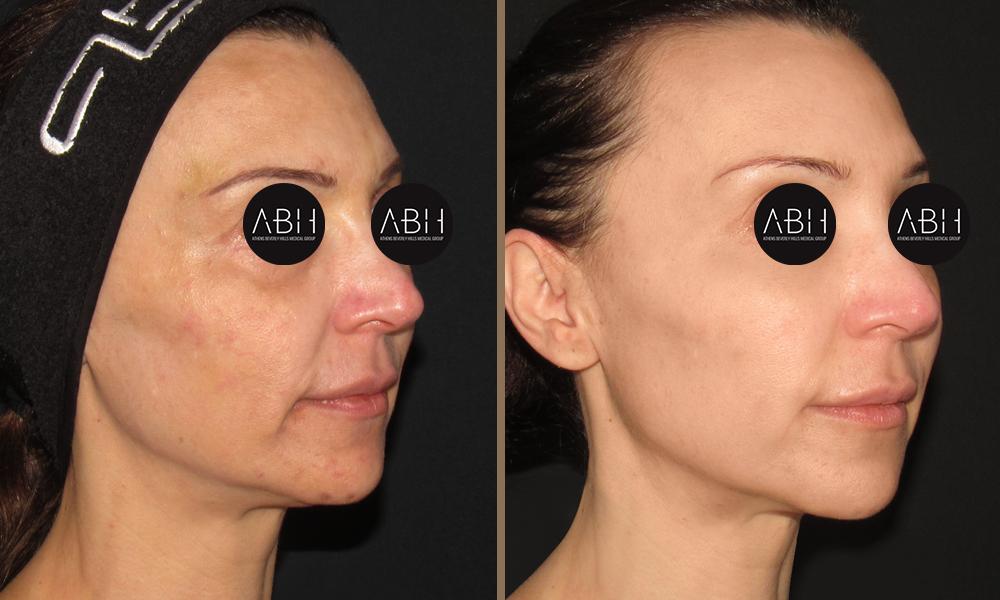 Biomimetic Peptide Protocol 11 Πριν & Μετά - Fillers Υαλουρονικού Οξέος