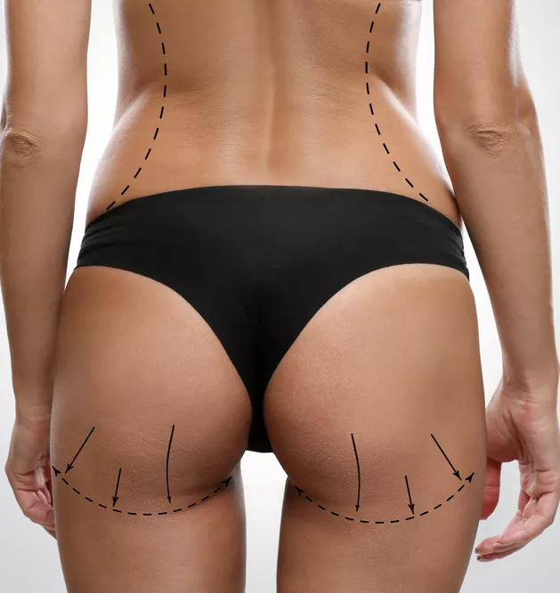 Buttock Augmentation