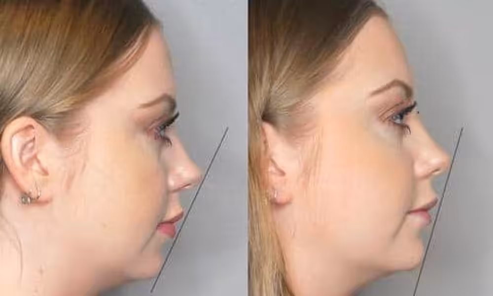 blog_profile_alignment_volux_chin_large-1