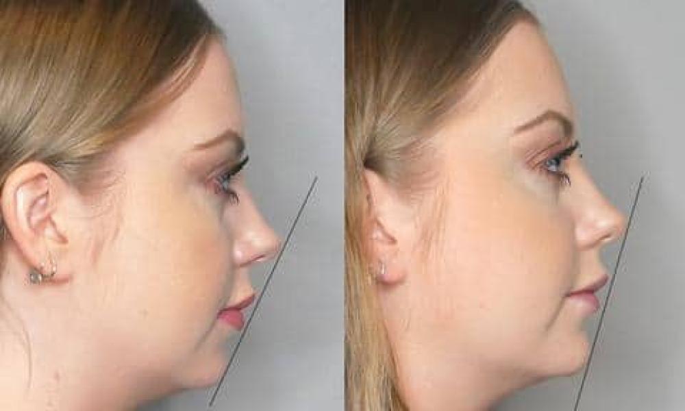 blog_profile_alignment_volux_chin_large-1