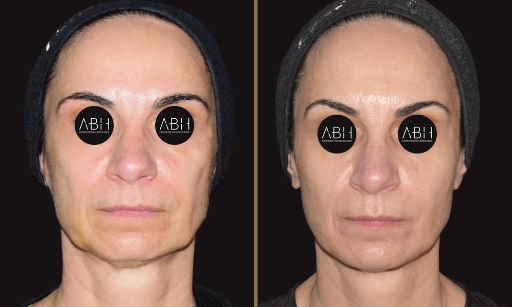 Biomimetic Peptide Protocol 12 Πριν & Μετά - Fillers Υαλουρονικού Οξέος
