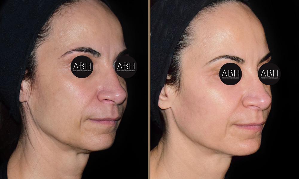 Biomimetic Peptide Protocol 13 Πριν & Μετά - Fillers Υαλουρονικού Οξέος