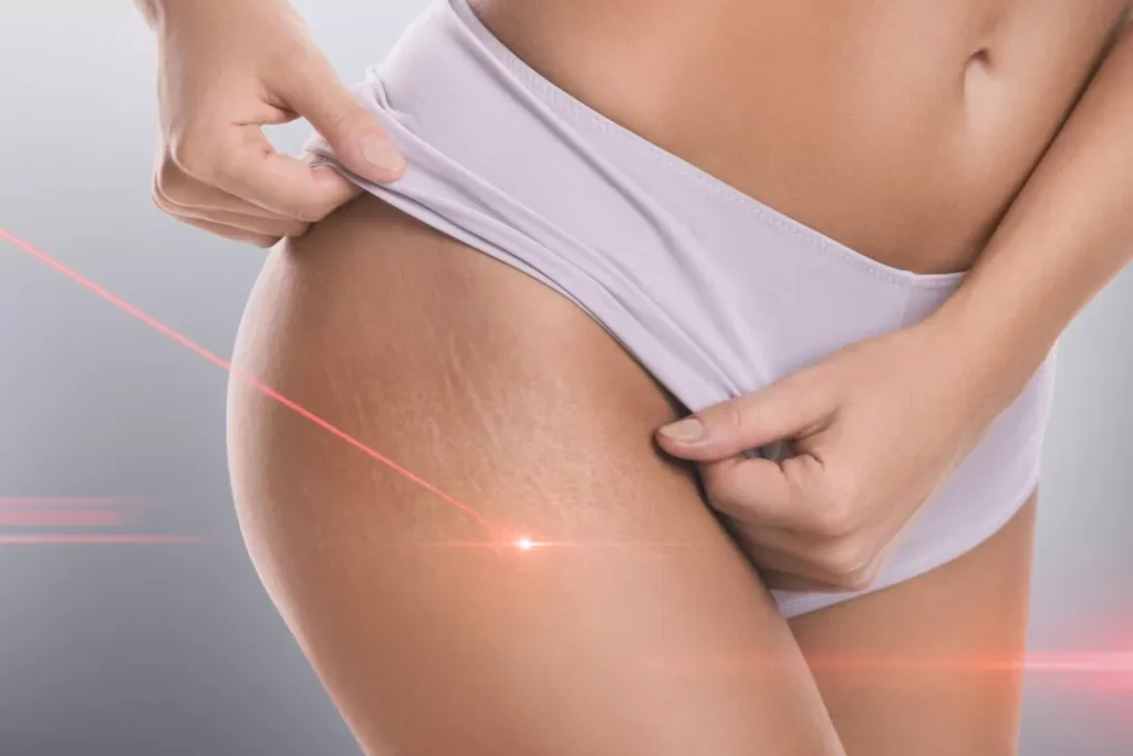 Uth Laser Ανάπλαση Δέρματος
