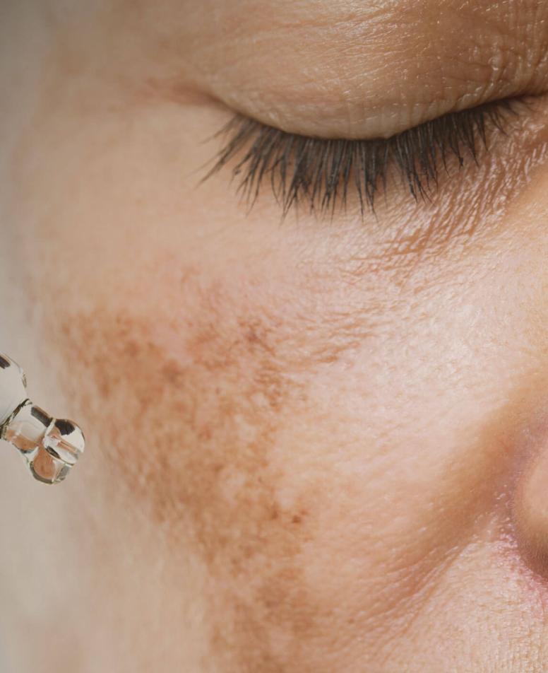 melasma