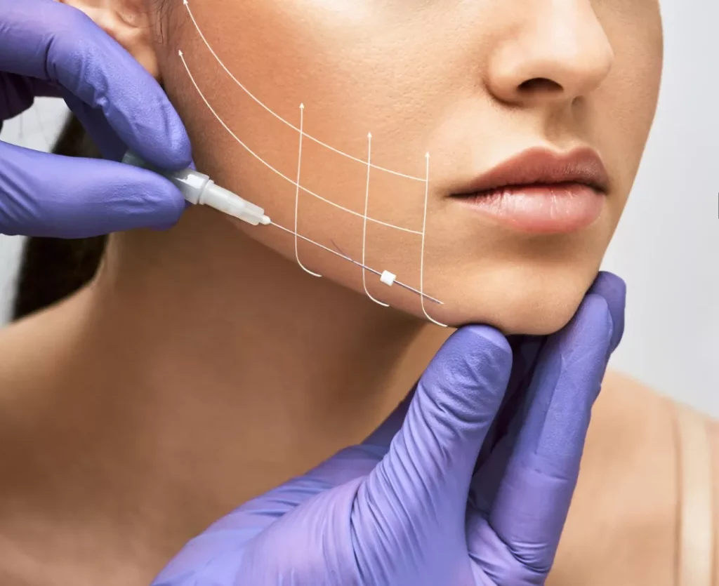 Thread Lift Treatment