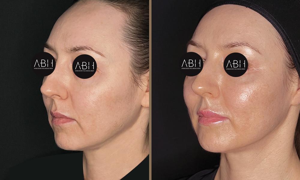 Biomimetic Peptide Protocol 15 Πριν & Μετά - Fillers Υαλουρονικού Οξέος