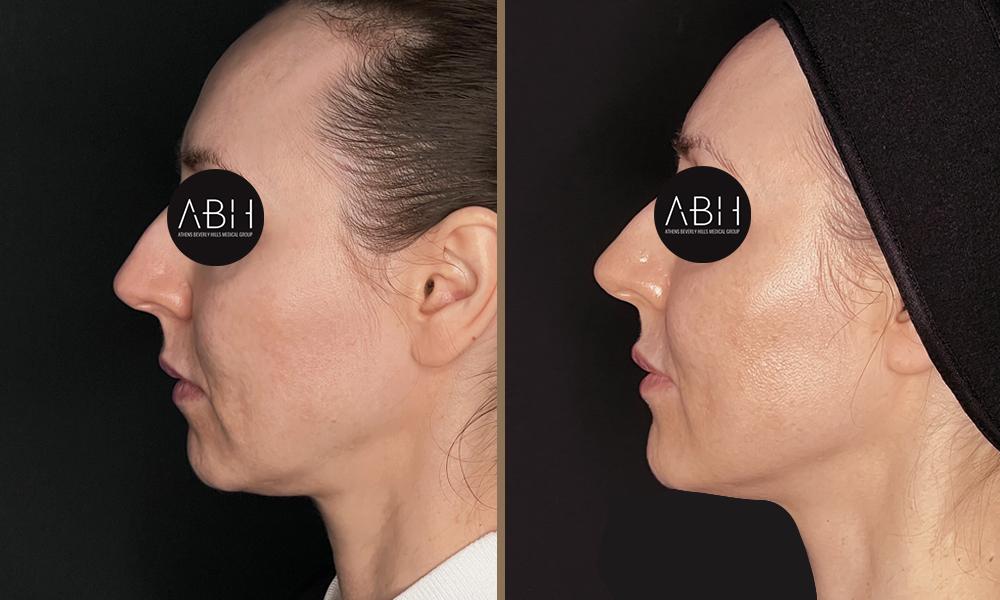 Biomimetic Peptide Protocol 16 Πριν & Μετά - Fillers Υαλουρονικού Οξέος